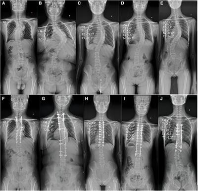 Correlation analysis and clinical significance of changes in upper thoracic vertebra tilt and clavicle angle pre- and post-operation